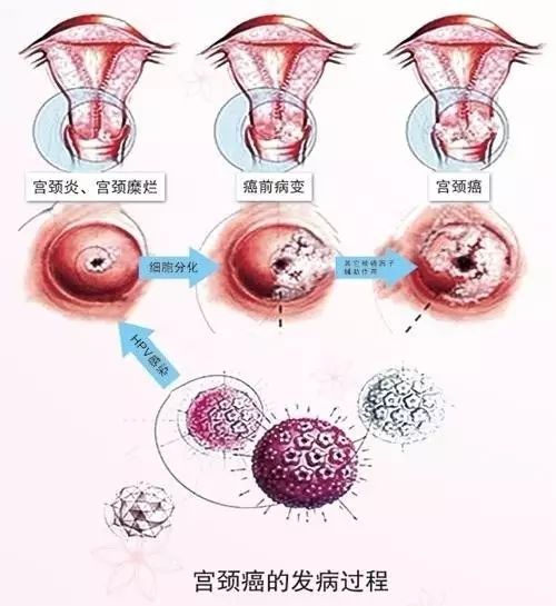 17岁花季少女患宫颈癌晚期，警示与反思