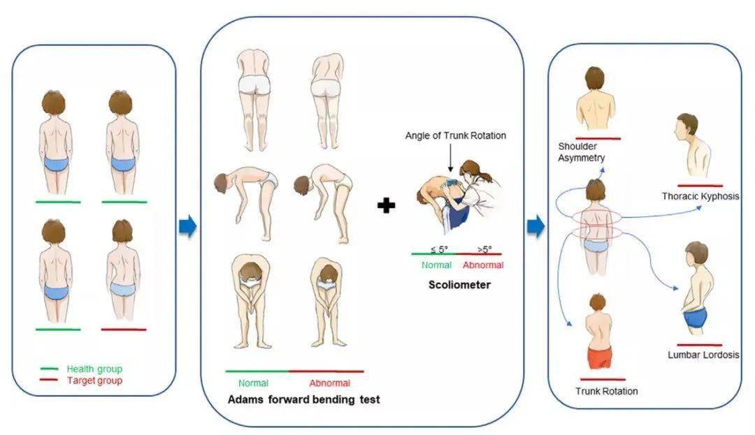 姿势性脊柱侧弯矫正方法与策略详解