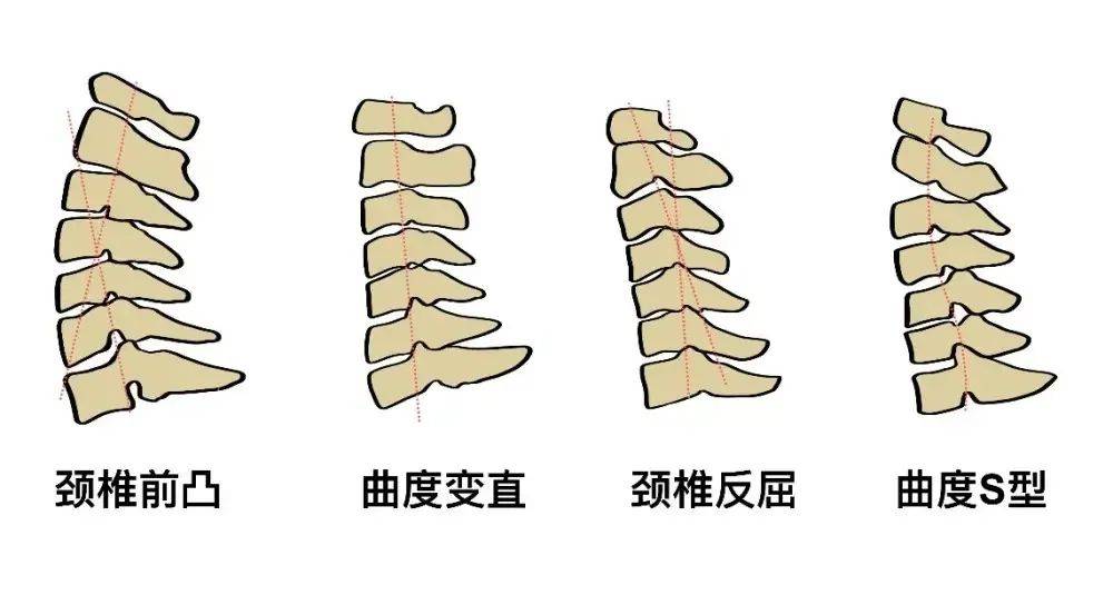 颈段脊柱生理曲度反弓，成因、影响及治疗方法探究