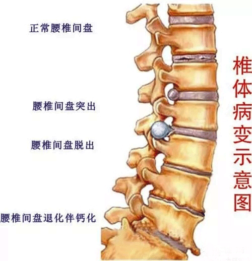 腰椎症状的表现与识别方法