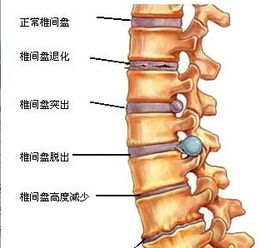 脊柱疼痛的主要症状及其对生活的影响