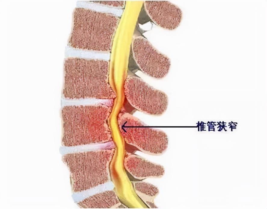 腰椎问题引发腿痛怎么办？全面解析及应对建议