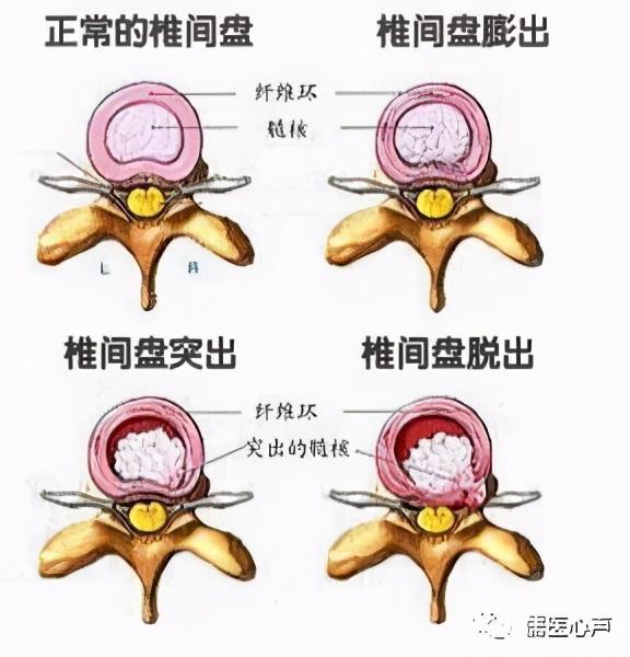 腰弯分型，全面解析与应对策略