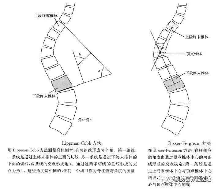 脊柱侧弯严重程度判断指南