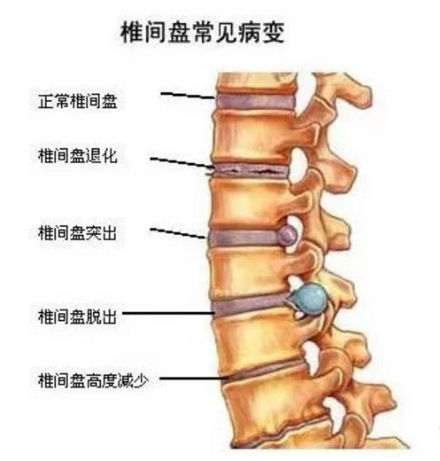 脊柱塌陷的自愈技巧及预防措施