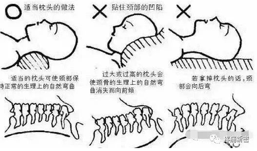 曲度治疗颈椎病的可能性研究