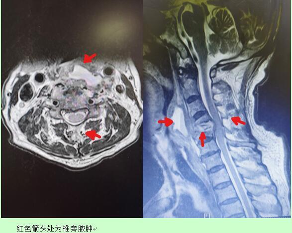 颈椎痛最佳消炎药，理解、选择与行动指南