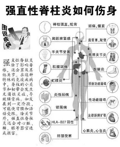 脊柱发炎的主要症状及其潜在影响