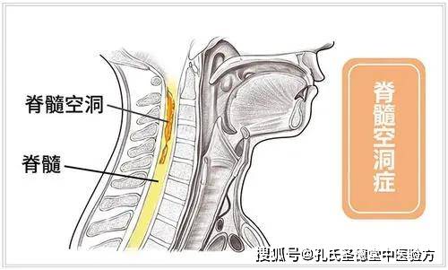 脊椎病与颈椎病的差异探讨