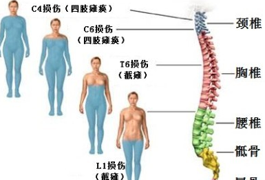 脊柱损伤的影响与后果分析