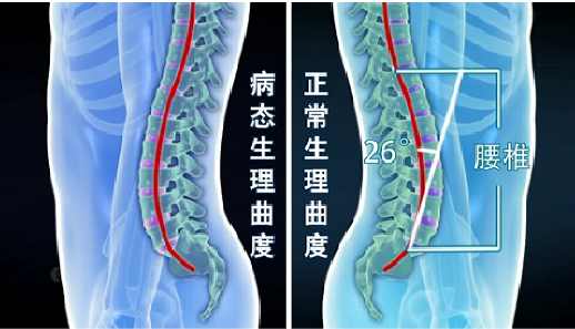 曲度牌腰椎治疗仪，疗效与实际应用探索