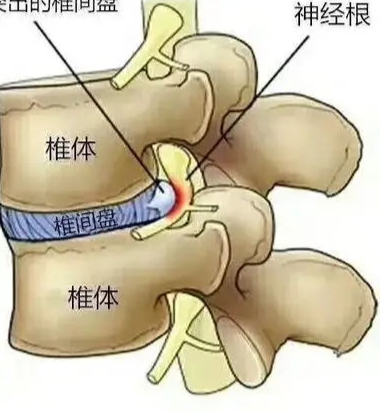 解析腰部舒缓架对腰椎间盘突出治疗效果及应对方法