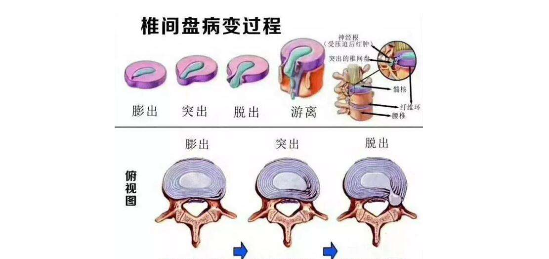 女性腰345膨出，警惕、预防与应对策略