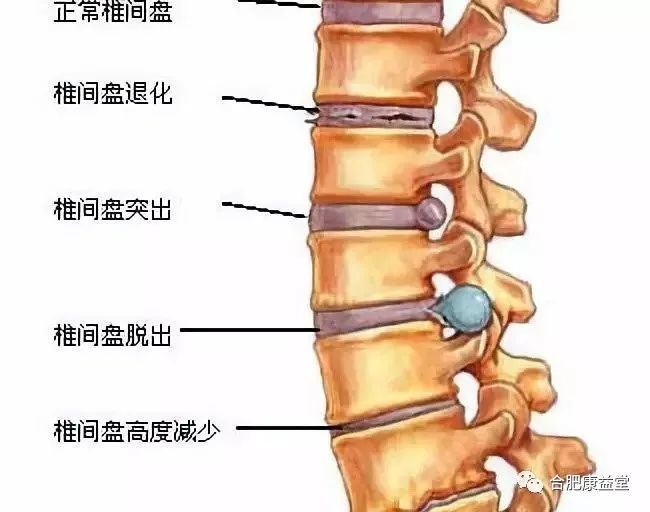 脊椎骨关节病，理解、预防与治疗指南