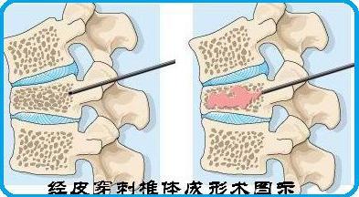 脊柱评估康复仪器的应用与发展概况