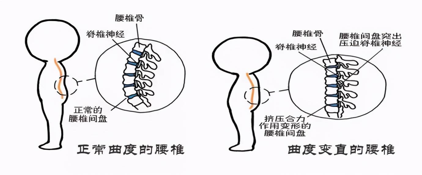 颈曲和腰曲正常范围解析，多少厘米内为健康考量？