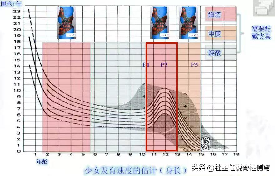 脊柱支具的作用，守护脊柱健康的关键守护者