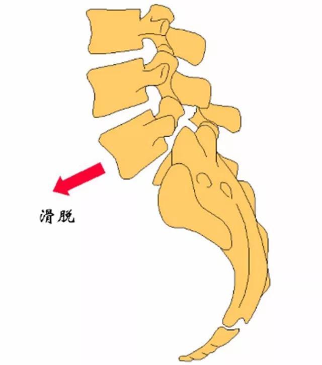 腰椎塌陷患者的寿命分析，影响因素及应对策略探讨