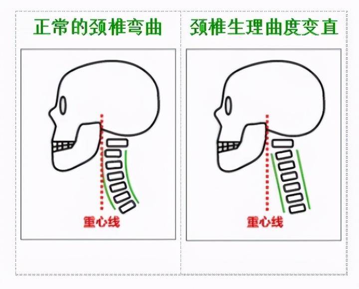 侧位生理曲度变直的深入研究