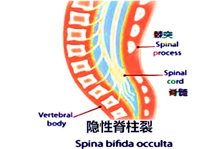 脊柱裂的形成过程解析