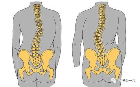 脊柱姿势性侧凸，常见疾病与关联分析探讨