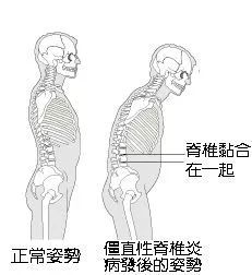 脊柱姿势不良的四大征兆解析