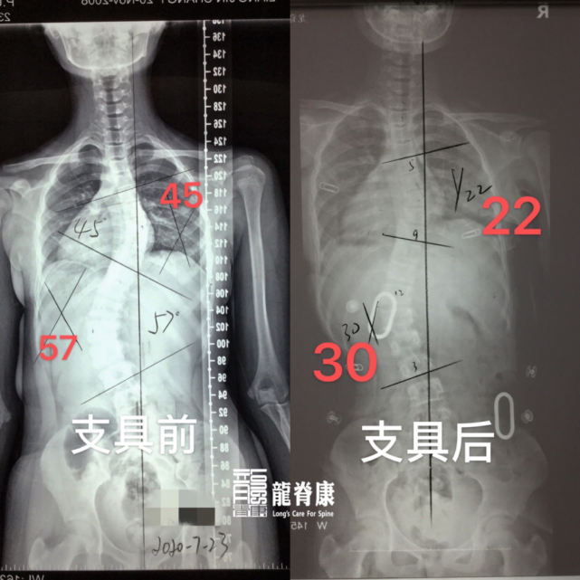 脊柱不稳定手术治疗策略详解