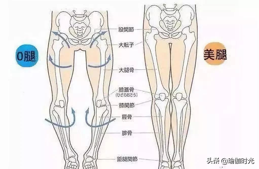 改善O型腿走路姿势，重塑步态，自信生活新篇章