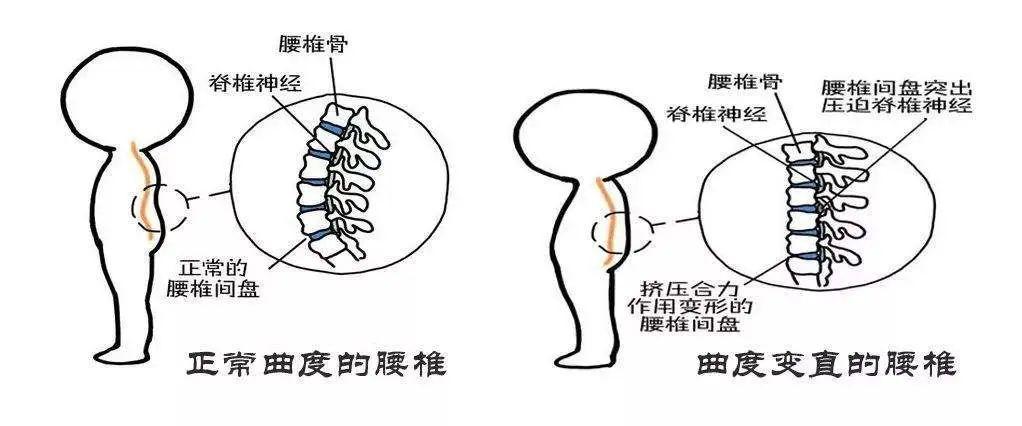 脊柱生理曲度变直，成因、影响及应对方法