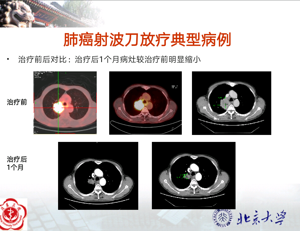 肺癌临床治疗的含义及其重要性解析