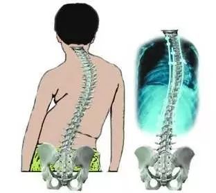 脊柱强直矫正方法详解及图片解析