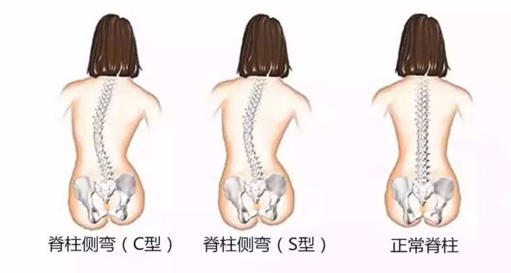 全方位守护脊柱健康，预防脊柱侧弯的方法